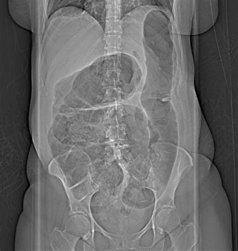 [Figure, Cecal Volvulus. An abdominal x-ray of...] - StatPearls - NCBI Bookshelf