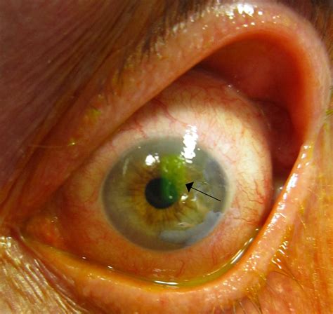 Recurrent Corneal Erosion (RCE) | Canadian Association of Optometrists