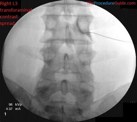 Fluoroscopic Guided Thoracic/Lumbar Transforaminal Epidural Steroid Injection - Technique and ...