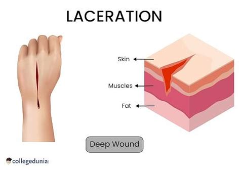 Laceration