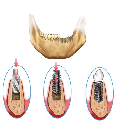 Dental Implant Types : Endosteal – root form