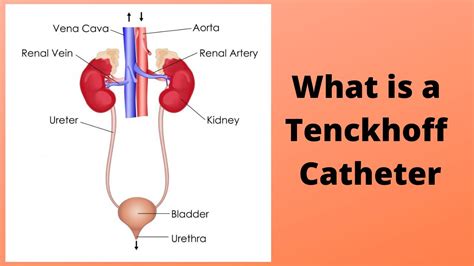 What is a Tenckhoff Catheter - YouTube