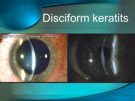 Disciform Keratitis