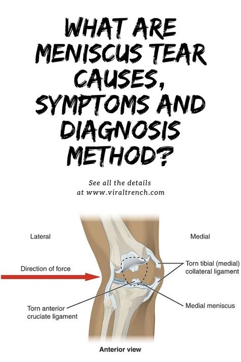 How Should I Sleep After Meniscus Surgery | roslonekyatayata