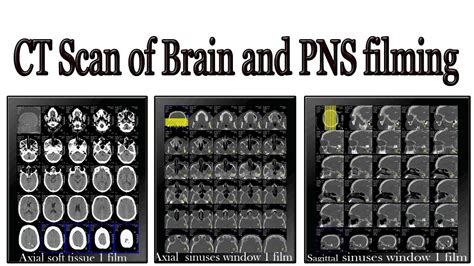 CT Scan of Brain and PNS Filming - YouTube