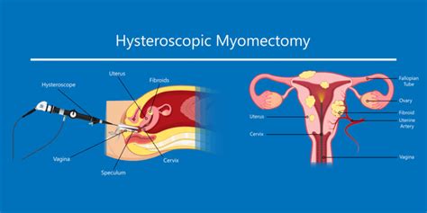 Outlook of Hysteroscopic Myomectomy - Pristyn Care