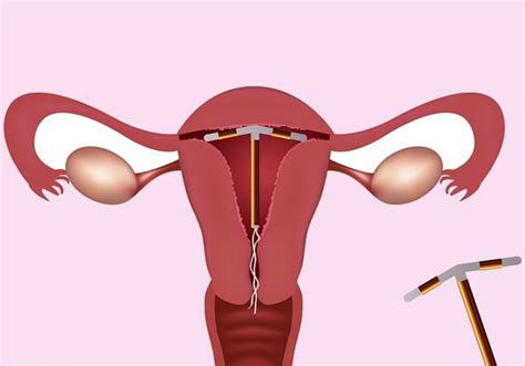 Intrauterine Devices (IUD) - London Obs & Gynae Clinic