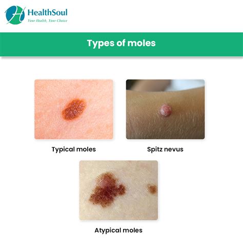 Moles: Symptoms, Types, Diagnosis and Treatment – Healthsoul