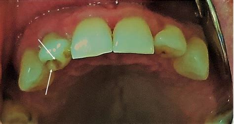 Case 2. Intraoral view of the maxillary showing the talon cusp and ...