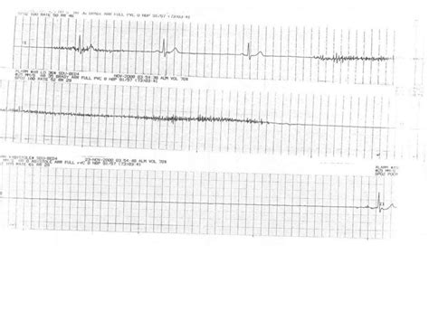 ECG Lecture: Sinus arrest, sinoatrial exit block, AV block and escape…