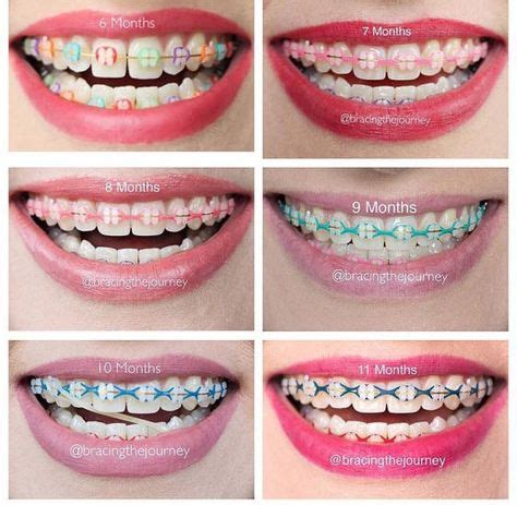 13 Best Ceramic Braces Colors images | Braces colors, Ceramic braces ...