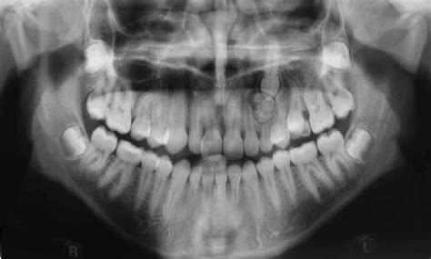 A complex odontome preventing eruption of \3. | Download Scientific Diagram