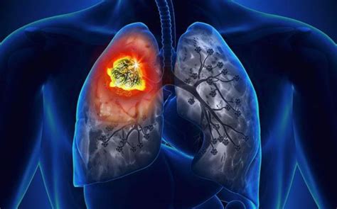 Carcinoid Tumor Lung Prognosis, Symptoms, And Treatment - CancerOz