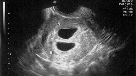 Ultrasound at 4 Weeks | New Health Advisor