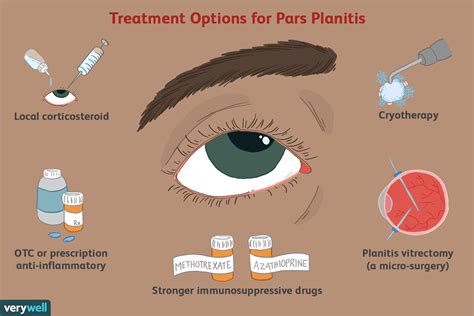 Pars Planitis Symptoms, Causes, and Treatment