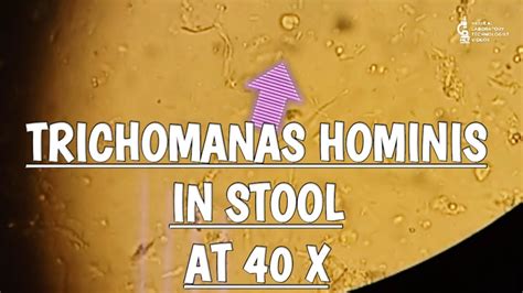 Trichomonas Hominis in stool microscopy at 40X. - YouTube