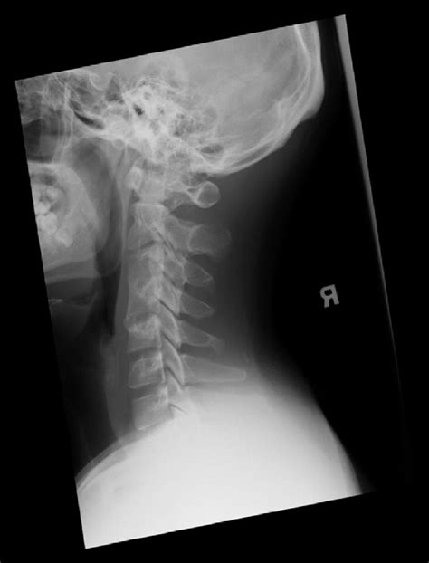 Postoperative radiograph showing solid fusion of C3 and C4 vertebrae ...