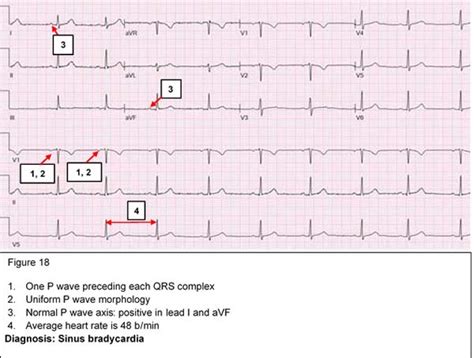 Arrhythmias