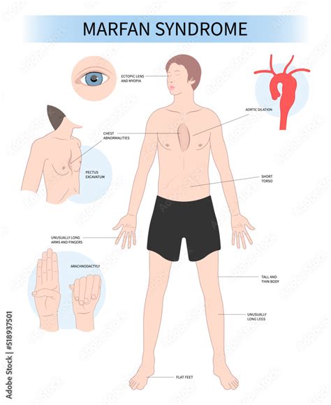 Marfan S Syndrome Genetic Condition Disease Enlar - buickcafe.com