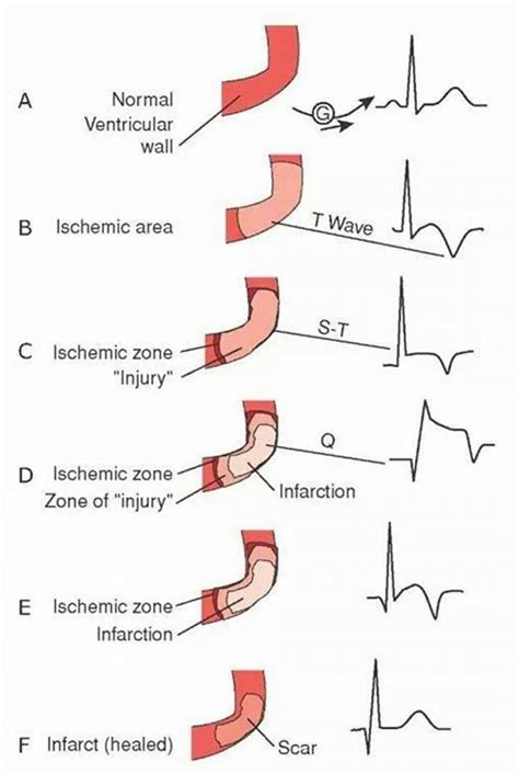 38 best Learning ECG Interpretation images on Pinterest | Cardiac nursing, Nursing schools and ...