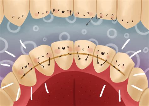 How Long Do Permanent Retainers Last? — Stroope Orthodontics