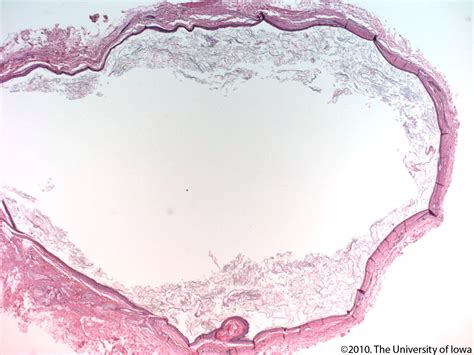 Dermoid Cyst. EyeRounds.org - Ophthalmology - The University of Iowa