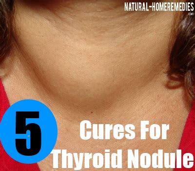 5 Natural Cure For Thyroid Nodules - Natural Treatment For Thyroid ...