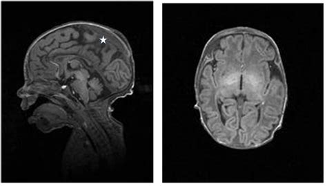 Megalencephaly and Epileptic Encephalopathy: Bad luck or a common pathway?