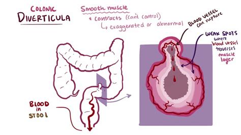 Diverticulitis Vs Diverticulosis