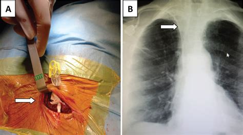 Complications after Totally Implantable Venous Port Catheter ...