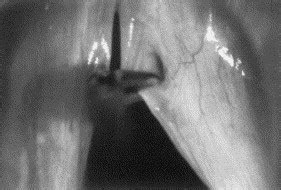 Surgical Management of Sulcus Vocalis and Vocal Fold Scarring ...