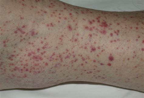 Study Medical Photos: A Case Of Purpura