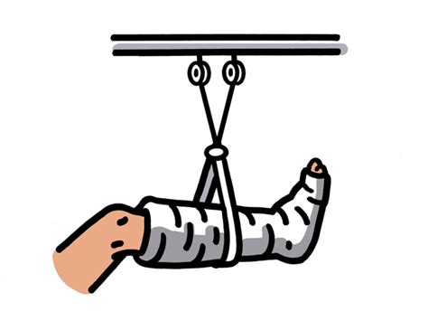 Bone Fracture Clipart - ClipArt Best