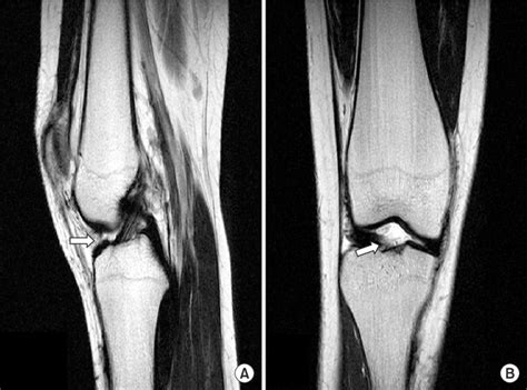 (A) (B) Case 1. MR images taken 20 months after surgery show ...