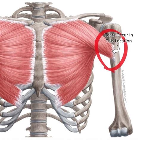 Pectoral Muscle Tear