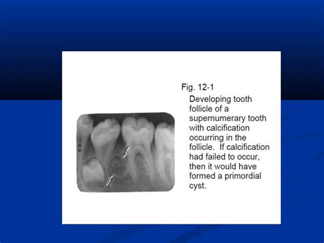 Odontogenic Cysts