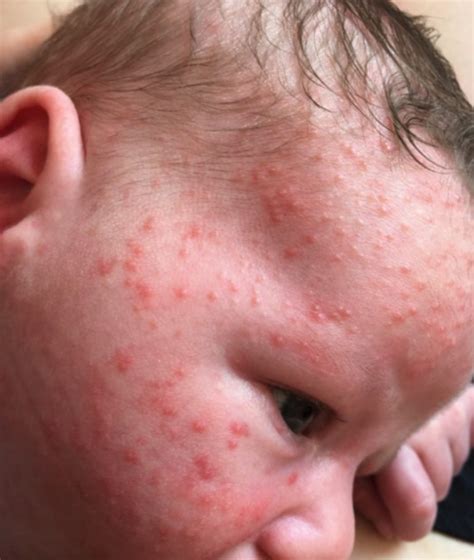 5 common skin conditions your baby may suffer with and how to treat it