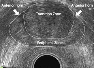 Ultrasound for Prostate Biopsy | Radiology Key