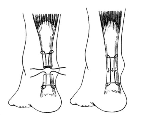 Achilles Tendon Surgery