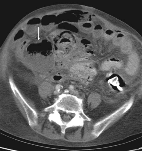 Stercoral Colitis Leading to Fatal Peritonitis: CT Findings | AJR