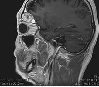 Cerebral MRI showing the contact of the left frontal sinus tumor with... | Download Scientific ...