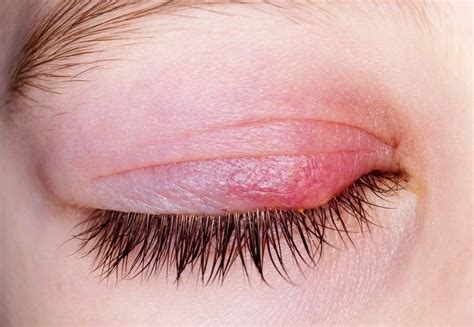 The 5 Most Common Eye Infections (And How To Avoid Them)