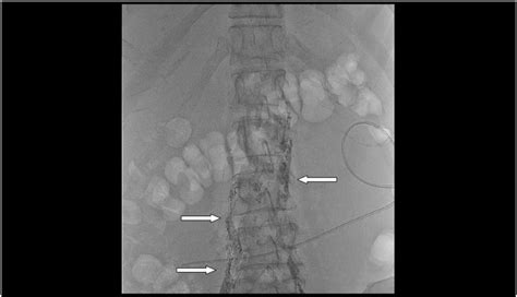 Female Patient With Massive Refractory Chylous Ascites Following ...