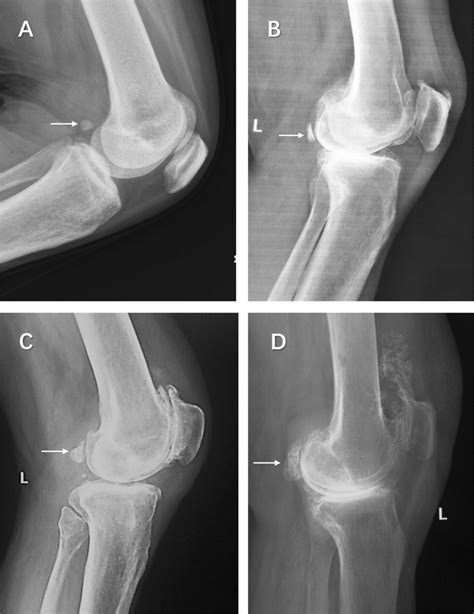 Different degenerated grades of fabellae are shown in lateral knee ...