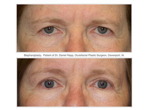 Drooping Eyelids and Eyelid Lifts