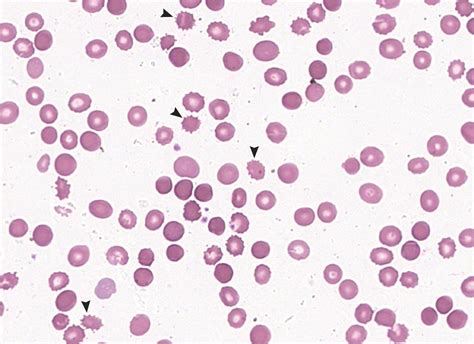 Spur-Cell Hemolytic Anemia | NEJM