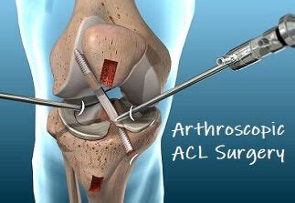 ACL Knee Surgery: What does it involve and how do you make the best ...