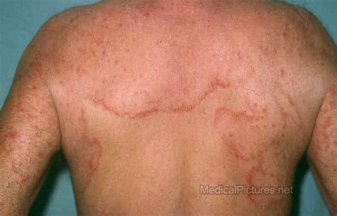 Pics Photos - Ringworm Skin Rash Picture