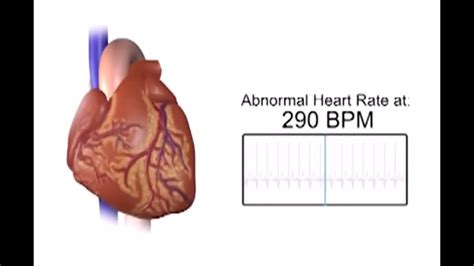 Inappropriate Sinus Tachycardia - YouTube