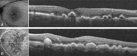 Spectral-domain optical coherence tomography of early onset large colloid drusen. | Semantic Scholar